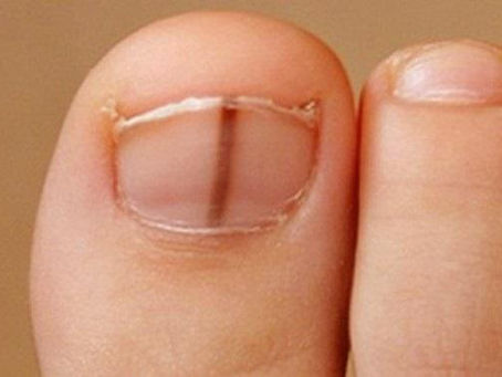 Skin Cancer of the Feet and Nails