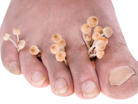Athlete's Foot - Not Just For Athletes