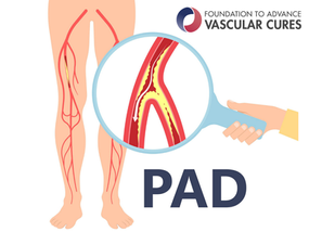 哪些人应当接受 PAD 筛查? (Who Should Be Screened for PAD?) (Flyer)