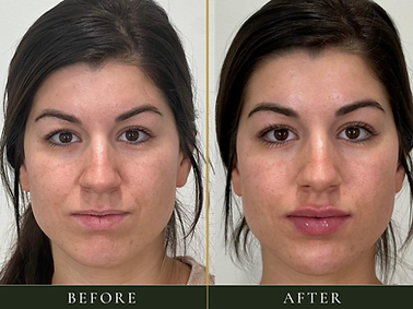facial-balancing-dermal-fillers