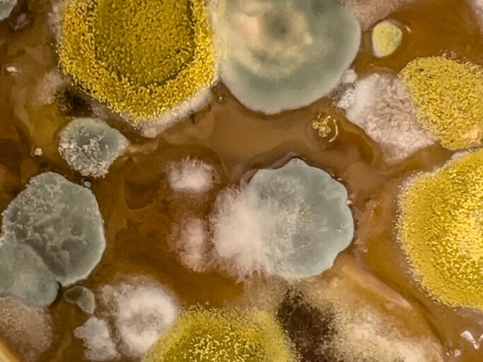 ¿Es peligrosa la infección por hongos en el oído?