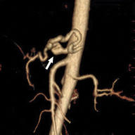 CT Angiography (CTA) in a vascular EDS patient