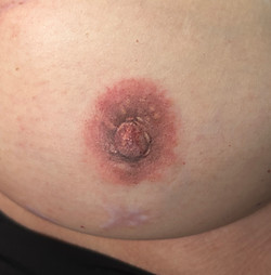 Brustwarzenrekonstruktion