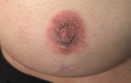 Bild einer tätowierten Brustwarze