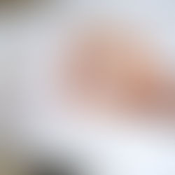 PEPTIC ULCER /ULCERA PEPTICA