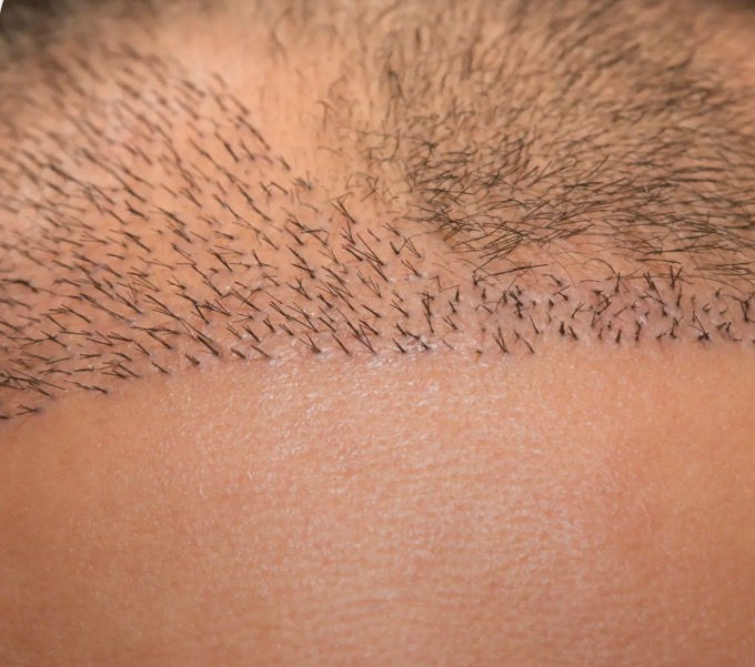 Figura 11.- dirección de implantación distinta