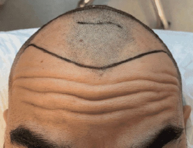 Figura 6 .- Limite anatomico del musculo frontal