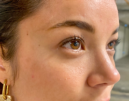 détatouage laser annecy 2.heic