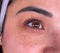 détatouage laser annecy 3.JPG