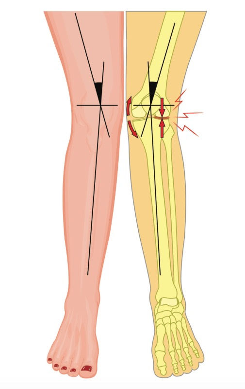 Why Do My Knees Hurt When I Exercise?