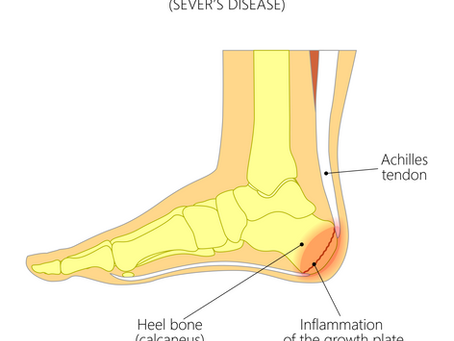 Sever’s Disease