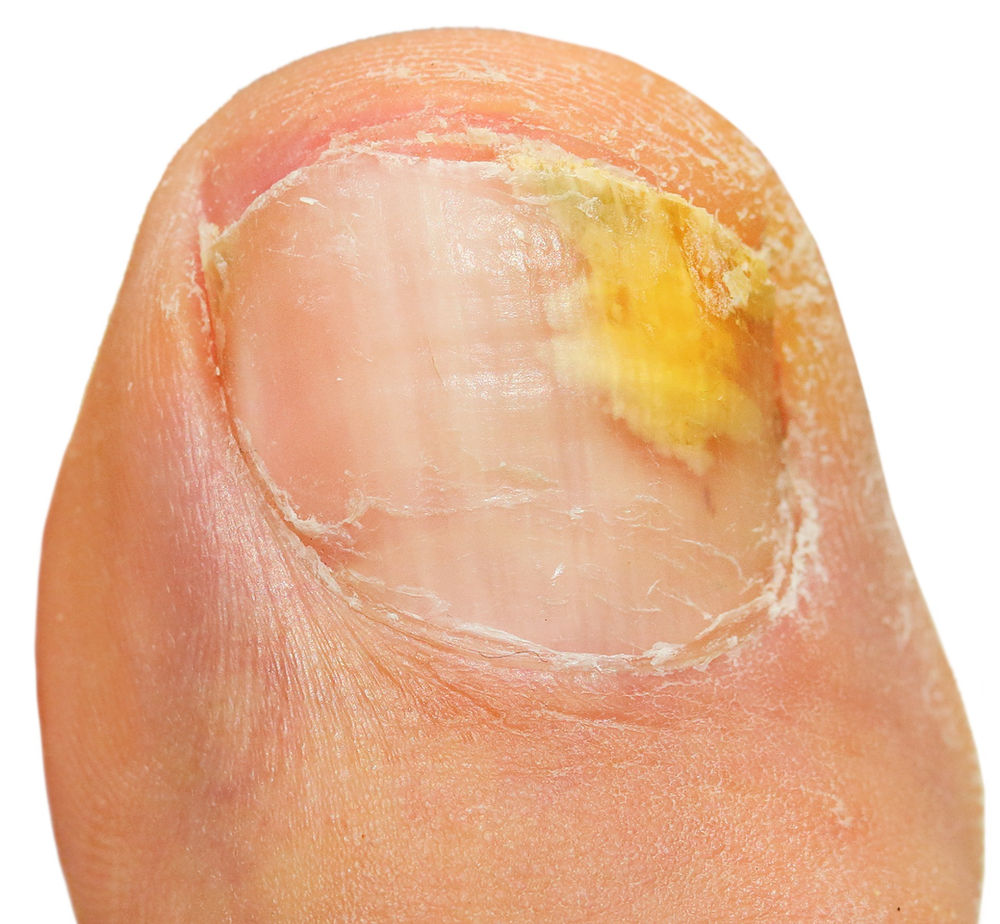 Why Is My Nail Discoloured?