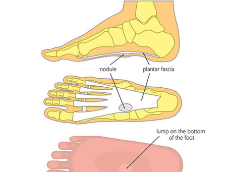 Plantar Fibromas