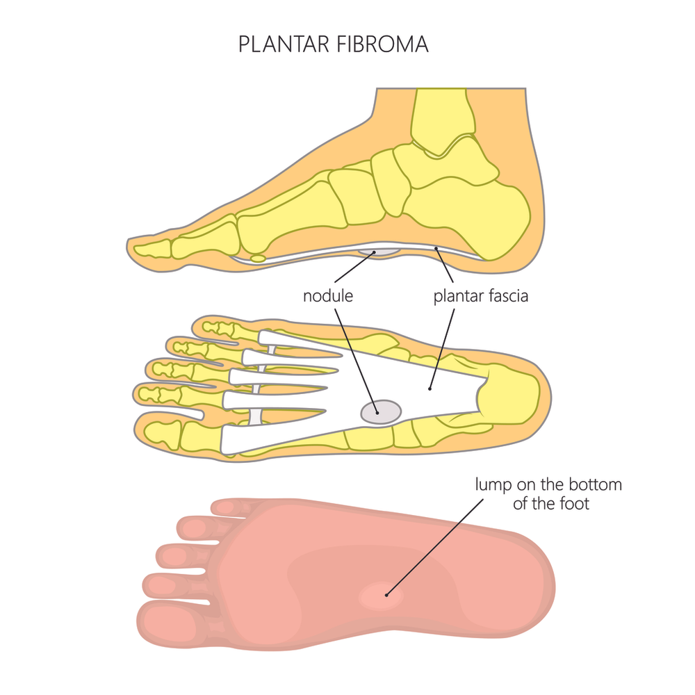 Plantar Fibromas