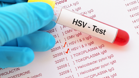 When To Get Tested For Herpes HSV1 & HSV2