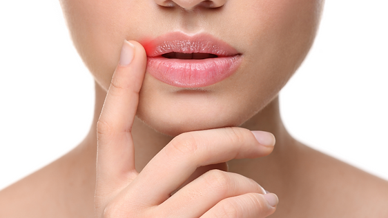 Cold Sores.png