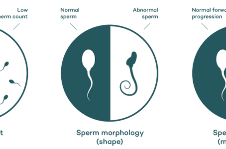 Male Infertility Explained: Azoospermia, Oligospermia & Asthenospermia