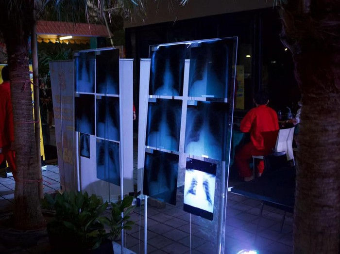 Vaper Melawan! Ramai-ramai, Pengguna Vape Pamer Foto Rontgen Paru-paru