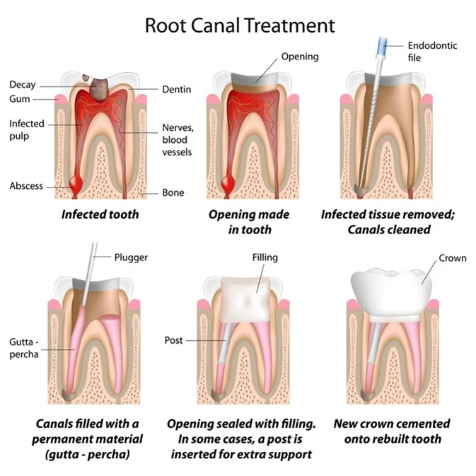 Steps of Root Canal Therapy