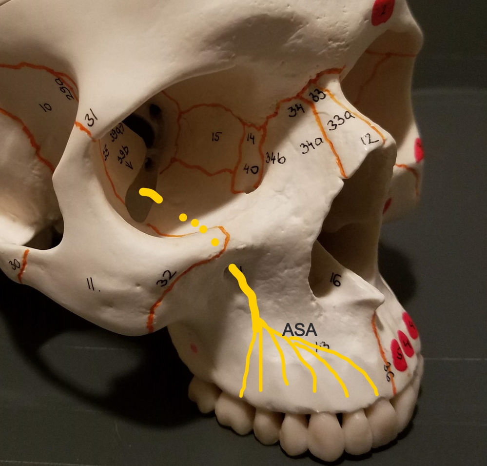 ANTERIOR SUPERIOR ALVEOLAR (ASA) INJECTION