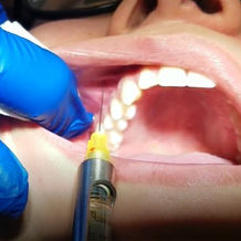 INFRAORBITAL INJECTION