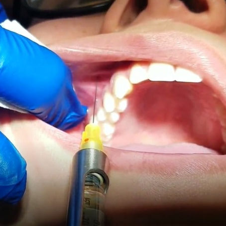 INFRAORBITAL INJECTION