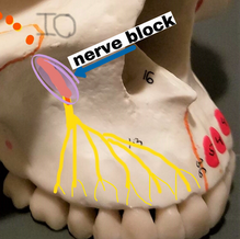 INFRAORBITAL INJECTION vs THE OTHERS?
