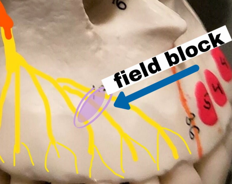 INFILTRATION vs NERVE BLOCK
