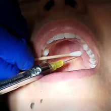 GREATER PALATINE INJECTION