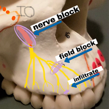 INFILTRATION -vs- NERVE BLOCK