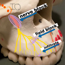 INFILTRATION -vs- NERVE BLOCK