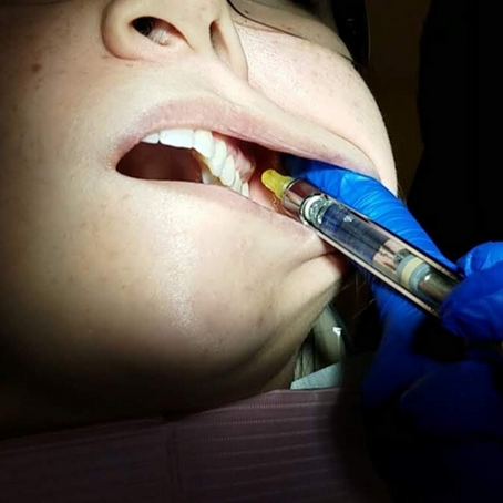 THE PSA INJECTION