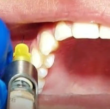 MSA INJECTION (Middle Superior Alveolar)