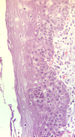 Epitelio plano estratificado