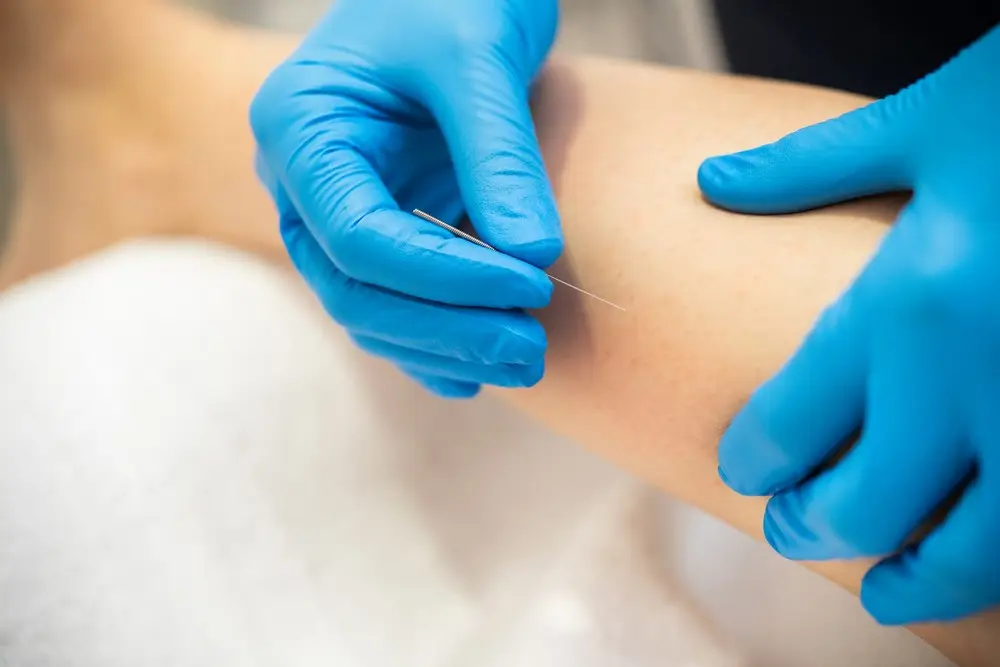 Close up of hands performing dry needling