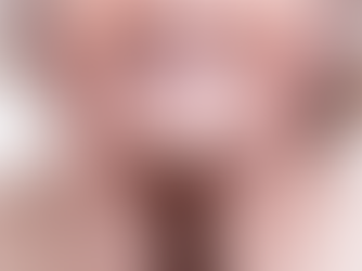 What Is A Denture Reline?