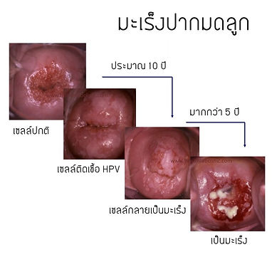 20181123-มะเร็งปากมดลูก-1024x1024.jpg