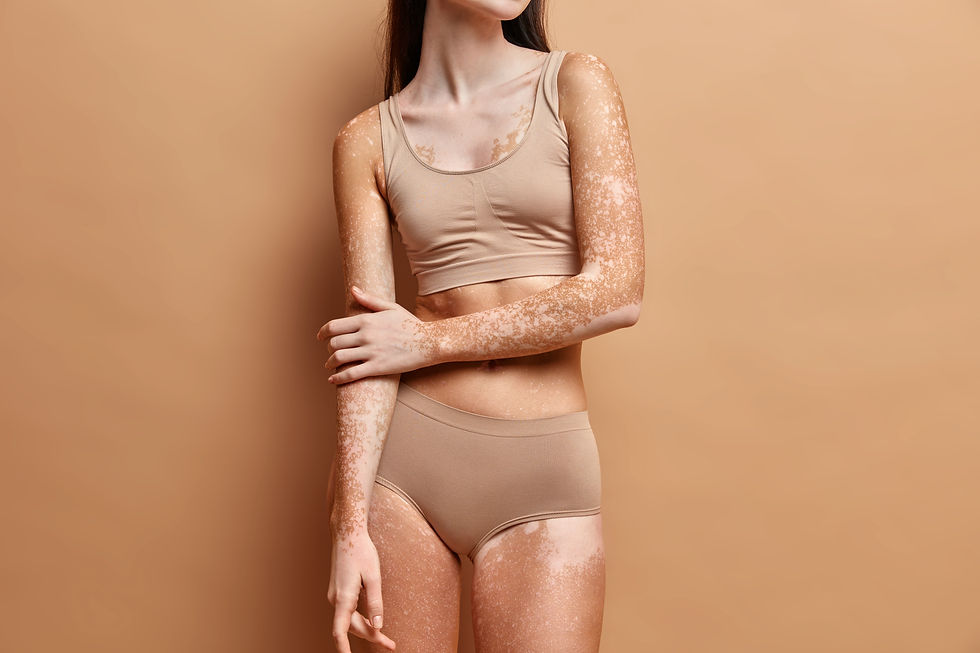 Vitiligo: entenda mais sobre essa condição e seus cuidados