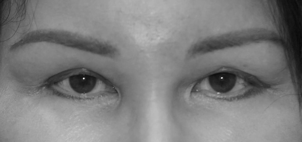 Patient 1 after_edited.jpg