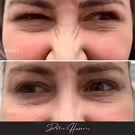 Bunny Lines Botox Kingston, Best Bunny Lines Botox Kingston, Bunny Lines Botox Clinic Kingston