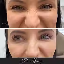 Bunny Lines Botox Kingston, Best Bunny Lines Botox Kingston, Bunny Lines Botox Clinic Kingston