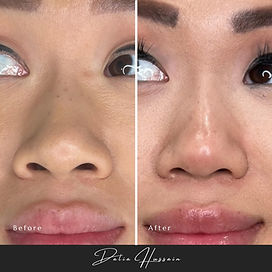 Nose Slimming Botox Kingston, Best Nose Slimming Botox Kingston, Nose Slimming Botox Clinic Kingston