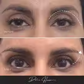 Best Botox Brow Lift Kingston, Botox Brow Lift Kingston, Botox Brow Lift Clinic Kingston