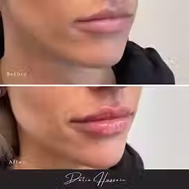 Chin Filler Kingston, Best Chin Filler Kingston, Chin Dermal Filler Kingston