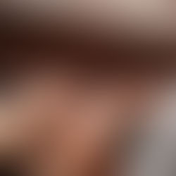 TMJD, Migraines and Tongue Posture: Why Where Your Tongue Rests Matters