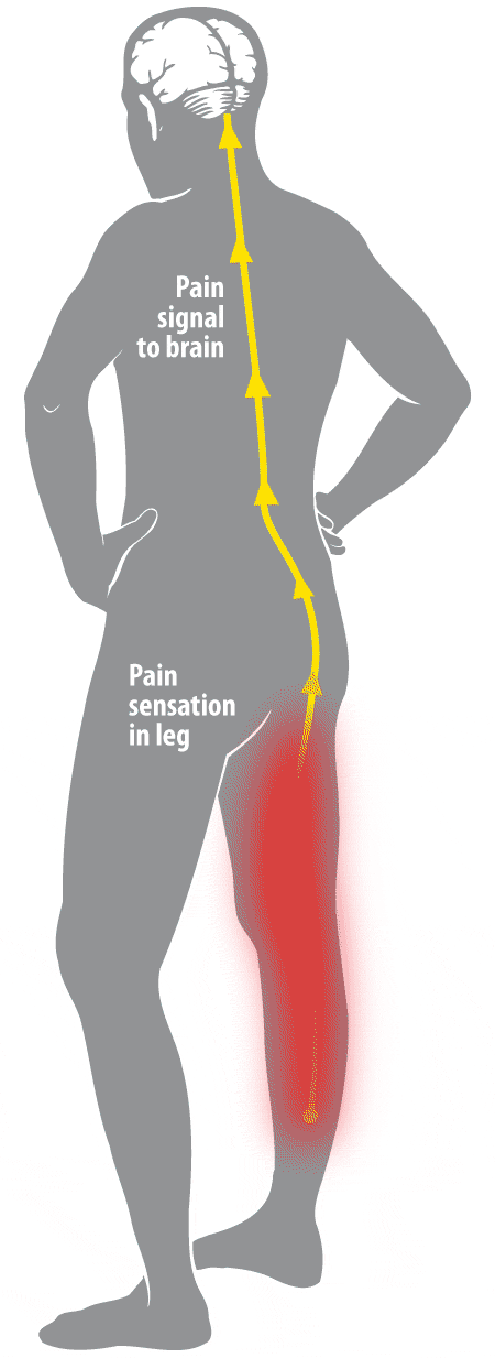 Spinal Cord Stimulation.gif