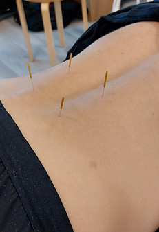 Dry Needling kuivaneulaus
