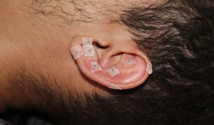 Auriculoterapia