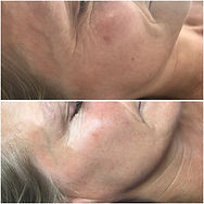Tri-Wave Rejuvenation.jpeg