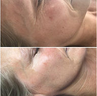 Tri-Wave Rejuvenation.jpeg